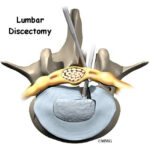 What is Microdiscectomy